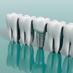 The Ultimate Guide To Endosteal Implant Surgery