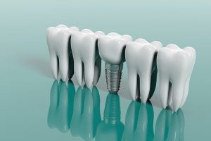 The Ultimate Guide To Endosteal Implant Surgery